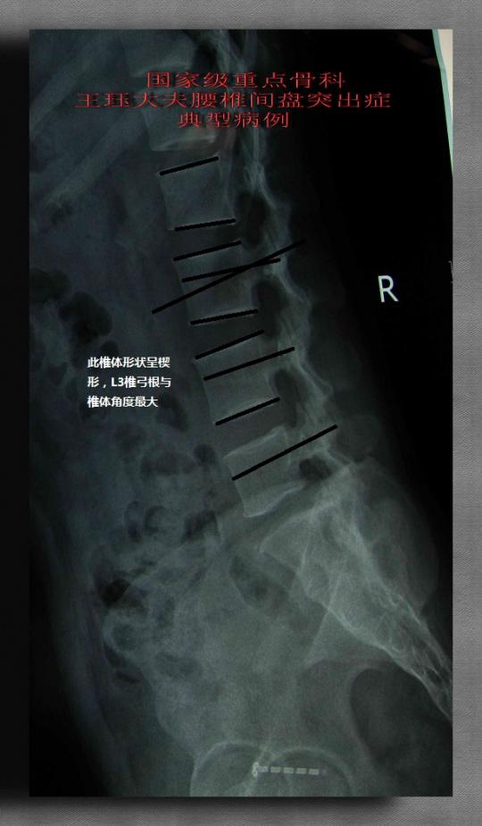 腰椎椎体形状总结(首创腰椎技术精要)