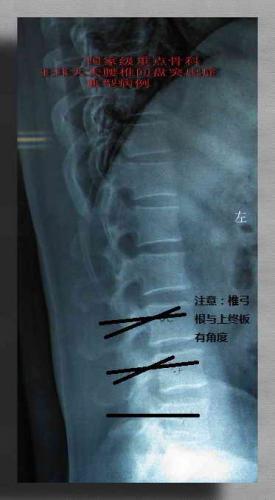 文章详情    根据腰椎椎体形状确定椎弓根进针点及方向(l2,l3,l4,l5)