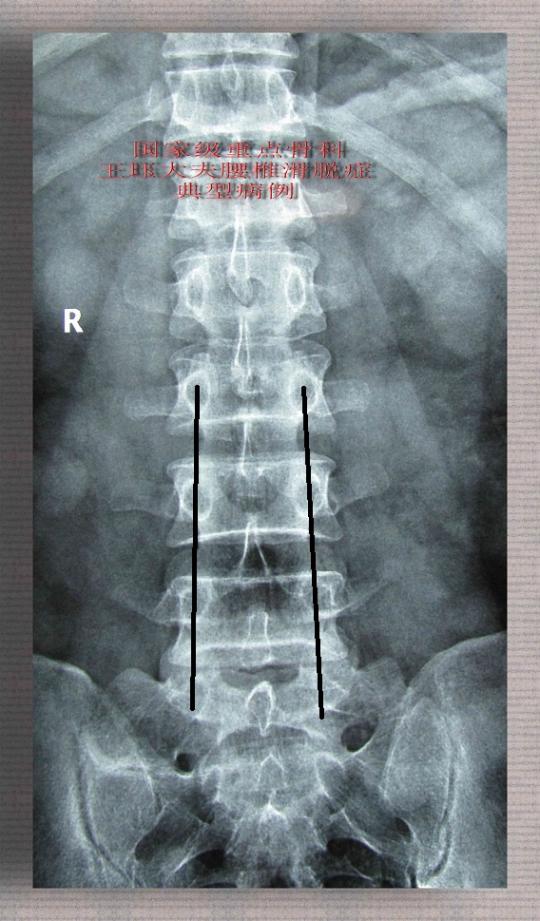 病例45:男,26岁,腰痛,滑脱或椎间盘突出,谁是真凶?