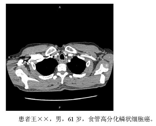 食管癌,肺癌切除术2例