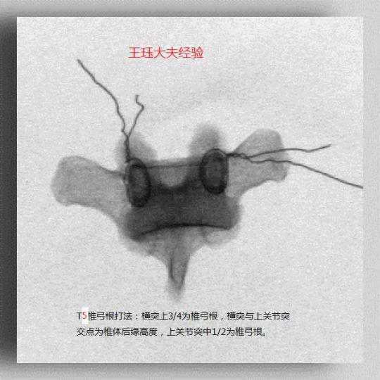 王珏大夫谈胸椎椎弓根位置经验