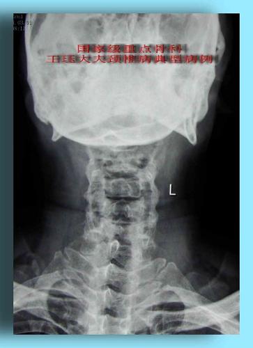 病例9:同时患颈椎与腰椎椎间盘突出,如何选择