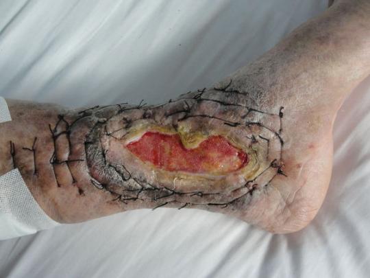 综合治疗下肢慢性顽固性溃疡_广安门中医院袁