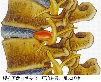 腰肌劳损还是腰椎间盘突出?_汕头大学医学院第一附属医院刘东昕_寻医问药专家网