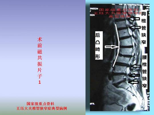 病例51:下胸椎,腰椎管狭窄并后凸畸形如何选择手术方式?