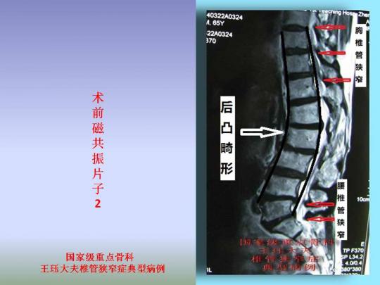 病例51:下胸椎,腰椎管狭窄并后凸畸形如何选择手术方式?