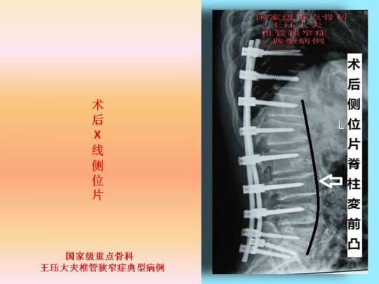 病例51:下胸椎,腰椎管狭窄并后凸畸形如何选择手术方式?