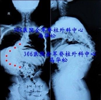 重度脊柱侧后凸分期手术治疗