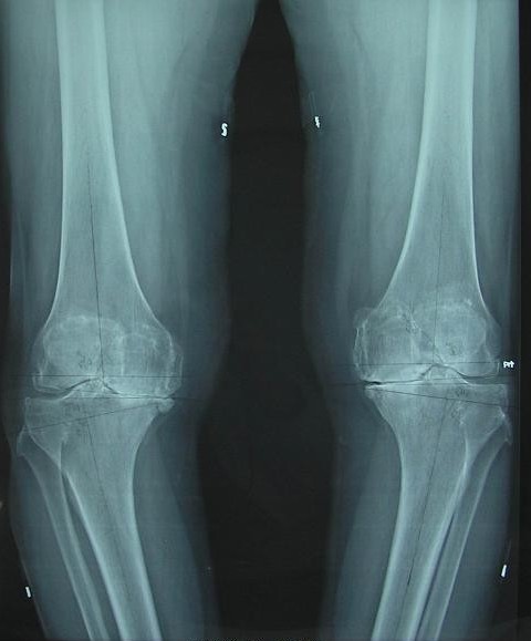 5.0 nexgen lps-flex人工全膝关节表面置换的