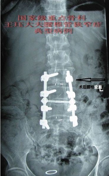 病例14:64岁腰椎管狭窄伴退行性侧弯症--术后可以正常
