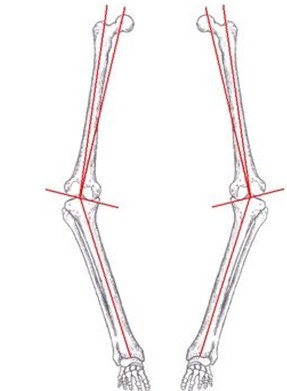 5.0 膝内翻(d形腿,o型腿,罗圈腿,弓形腿,箩筐腿)的定