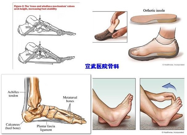 跖筋膜炎的锻炼方法