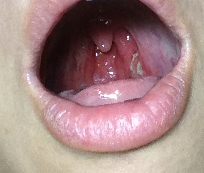 扁桃体不肥大,蜂窝组织炎_湖南省中医附一医院