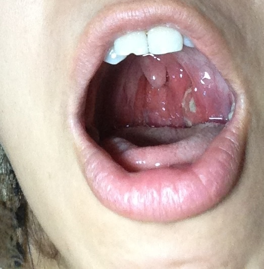 扁桃体不肥大,蜂窝组织炎_湖南省中医附一医院