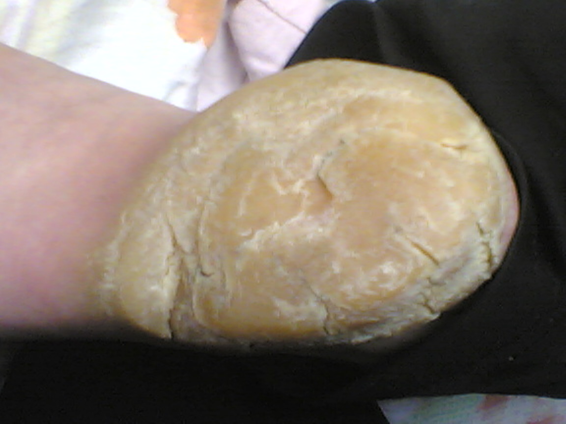 可否能治疗皮肤病鹅掌风_河北省中医院王根会专家网站_寻医问药专家网