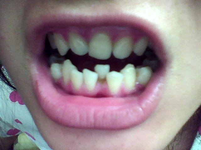 问题:牙齿排列不齐怎么整