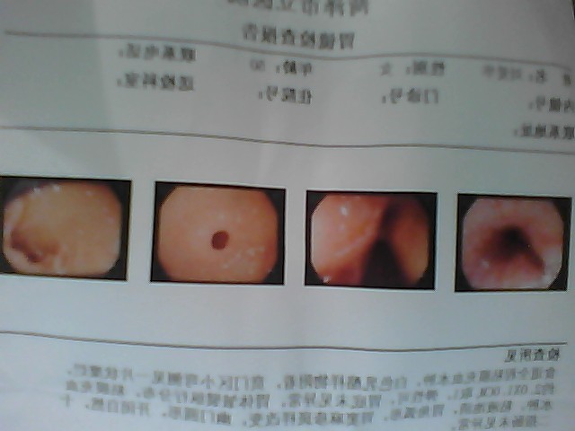 >> 文章内容 >> 糜烂性胃炎怎么用药 胃溃疡和糜烂性胃炎有什么区别答