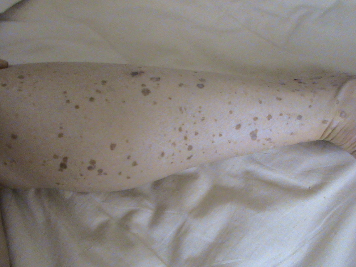 四肢长斑15年,不疼不痒,部分斑块凸出皮肤,是啥