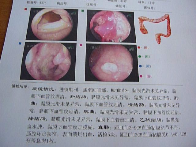 距肛门3-9cm直肠粘膜结节不平,肠腔环形狭窄,表面溃烂