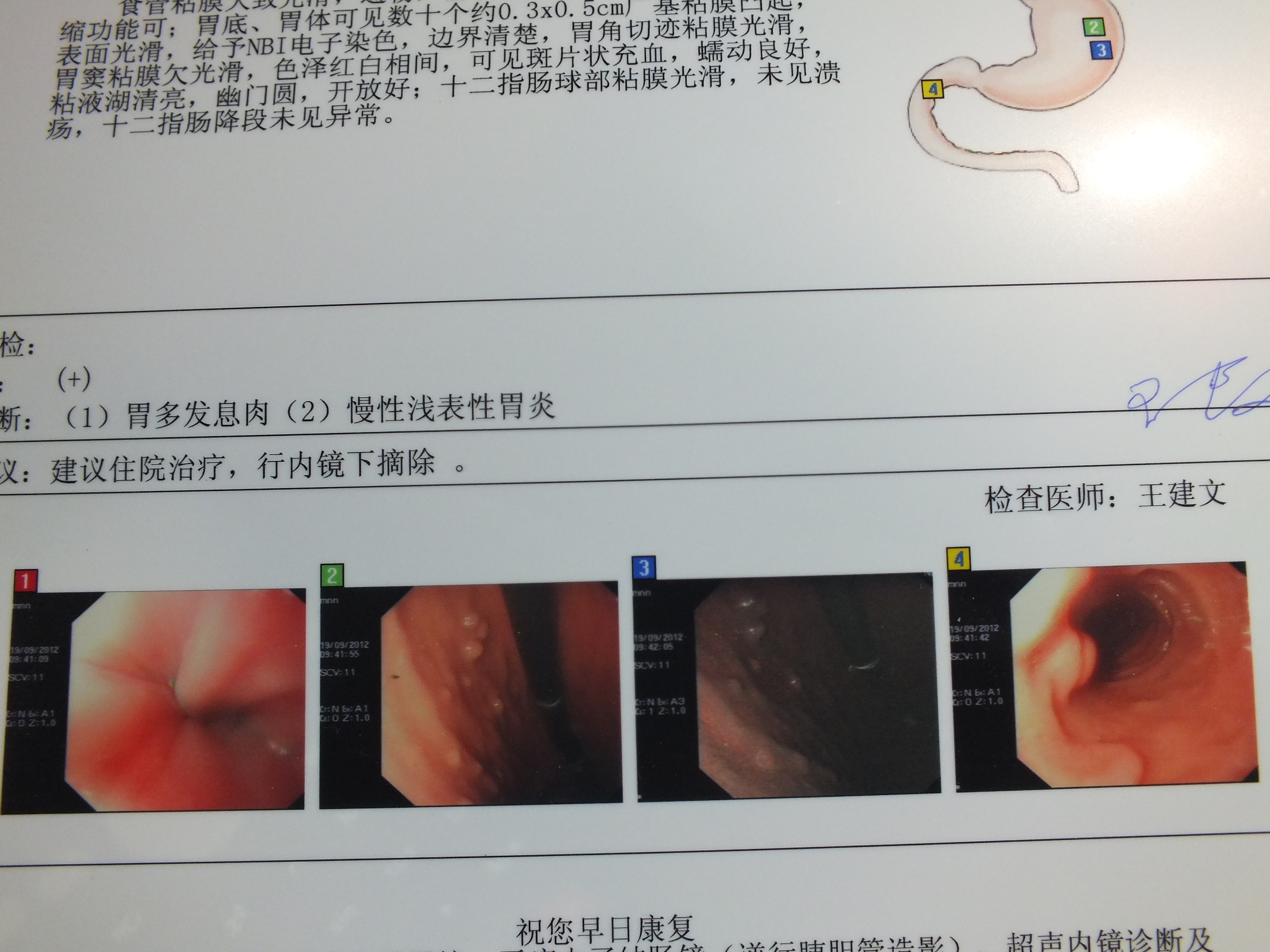 问题:胃多发性息肉可以保守治疗吗?如果手术后会不会复发