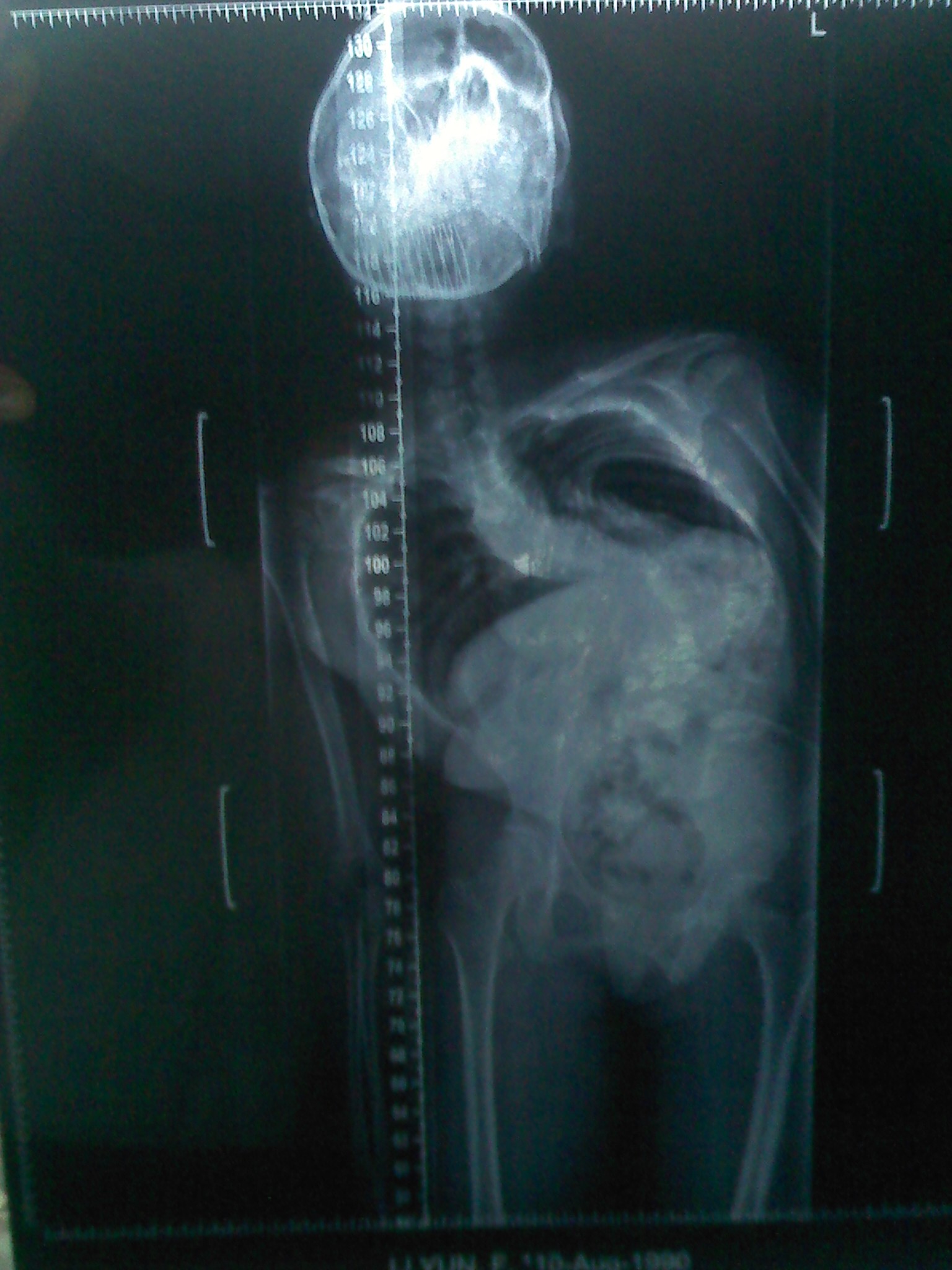 问题:脊柱侧后凸严重伴有先天性脊椎裂,谁来主刀