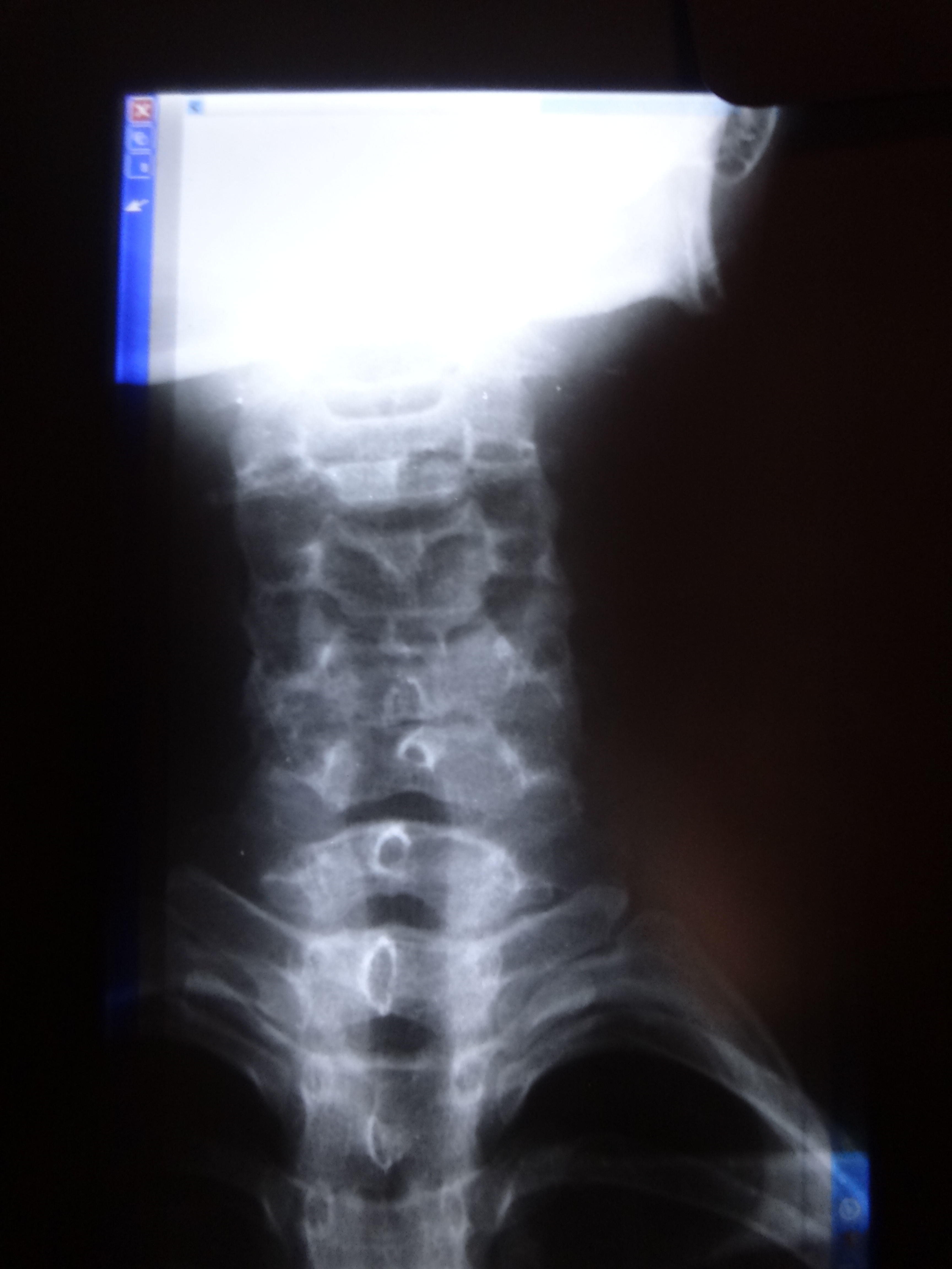 请问颈椎囊肿是应该挂骨科还是神经外科,需要