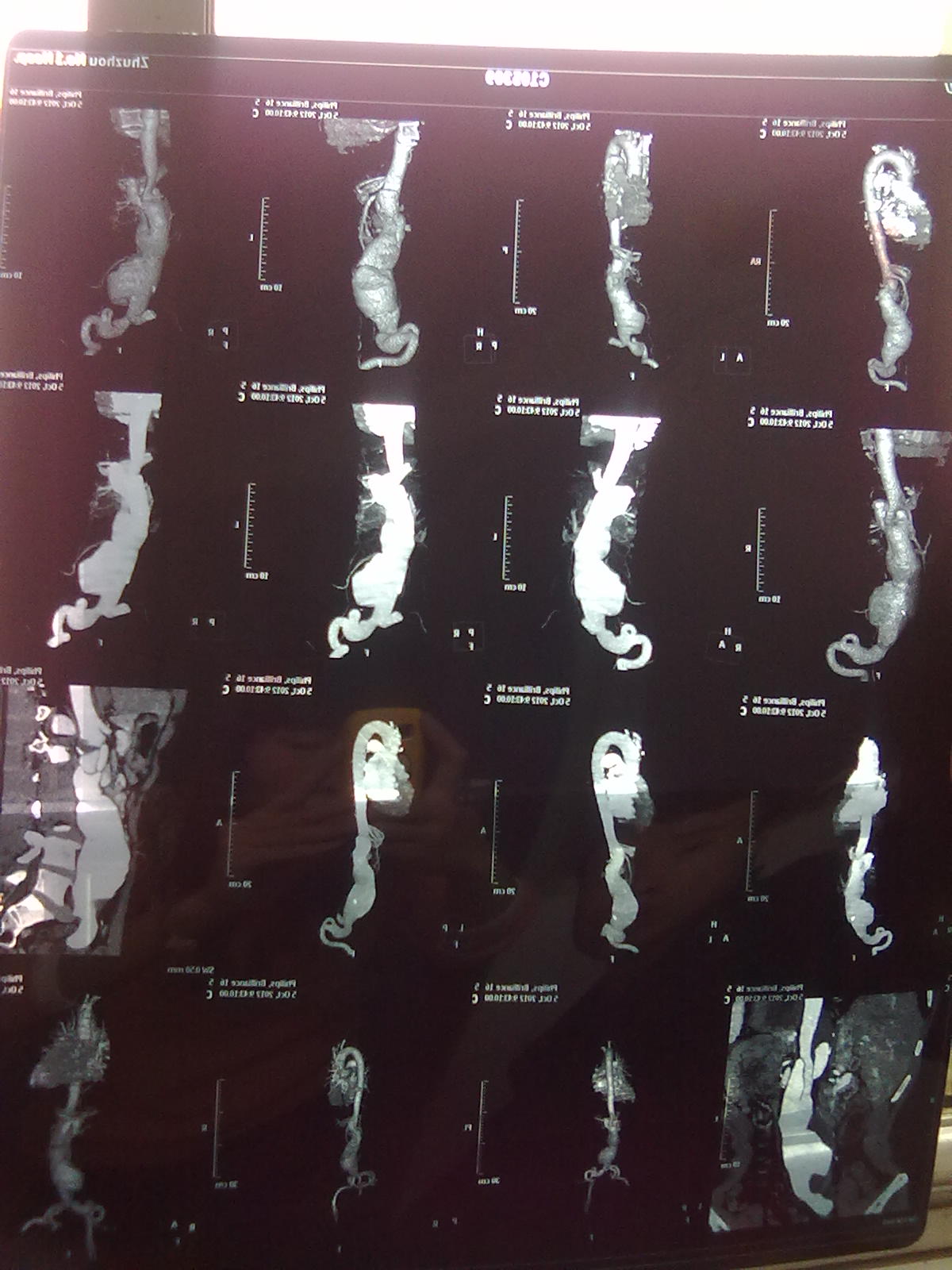 肾上动脉夹层和肾下动脉瘤,怎样治疗?_广州市