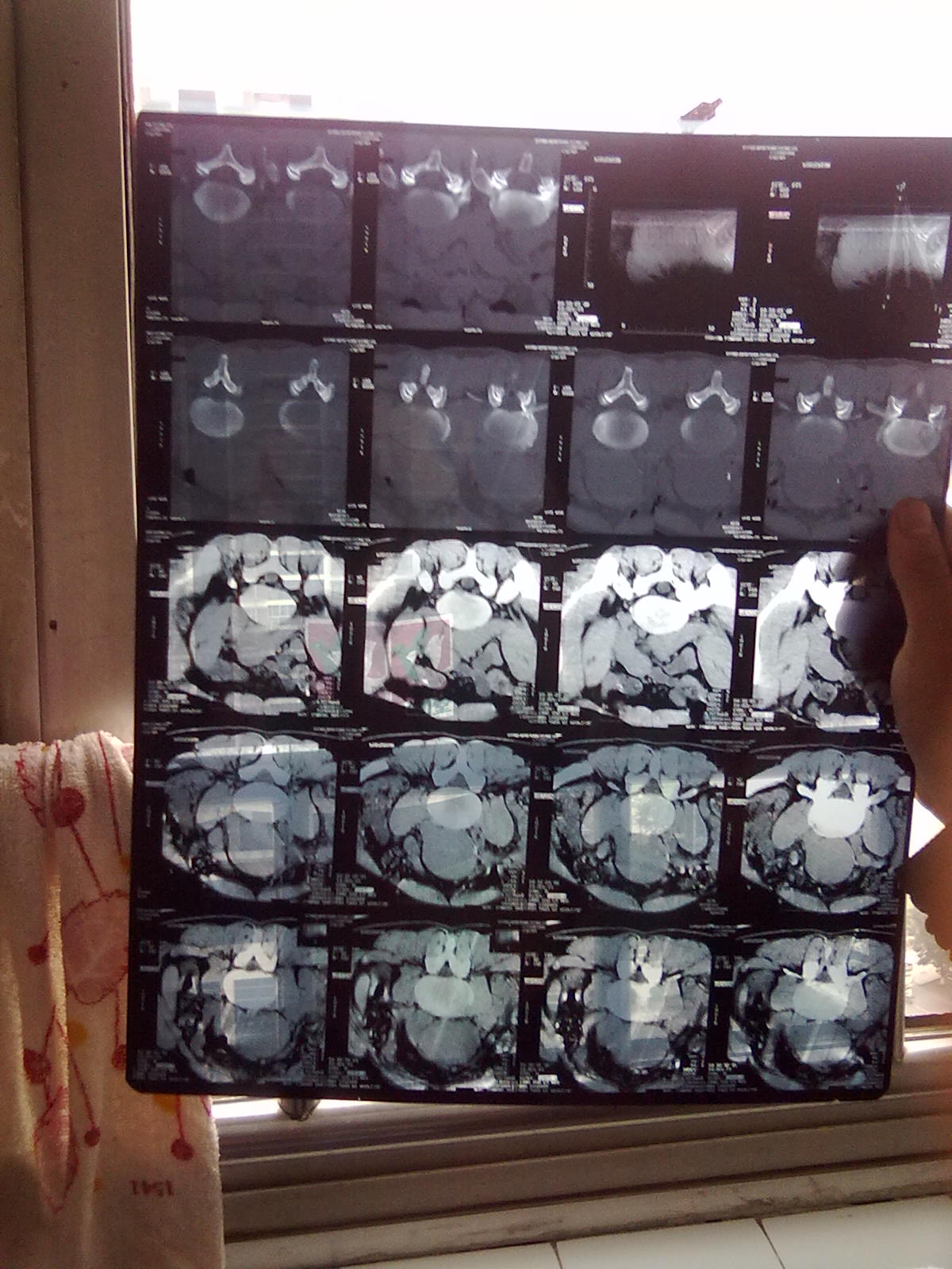 肾上动脉夹层和肾下动脉瘤,怎样治疗?_广州市