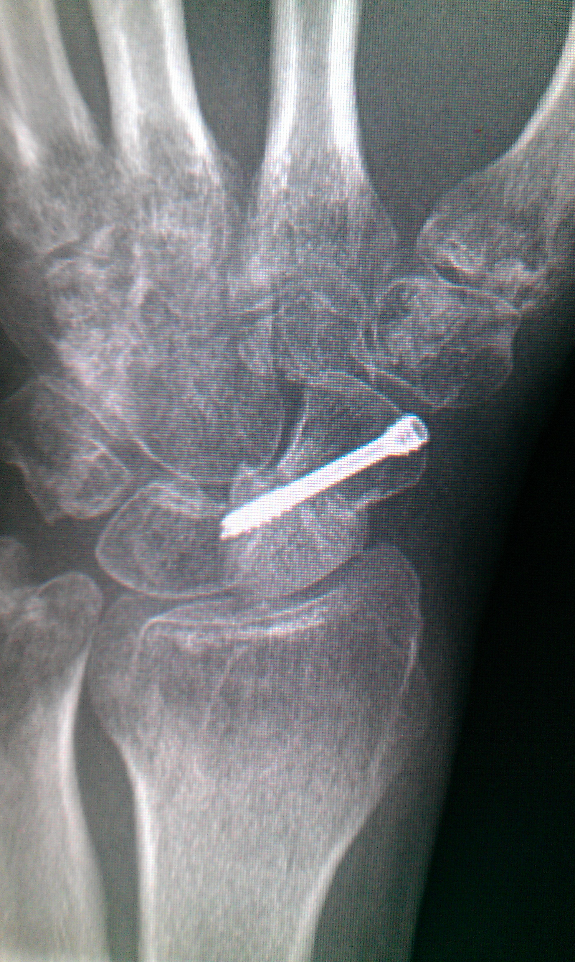 问题:左手舟状骨骨折内固定手术3个月没有愈合怎么办?