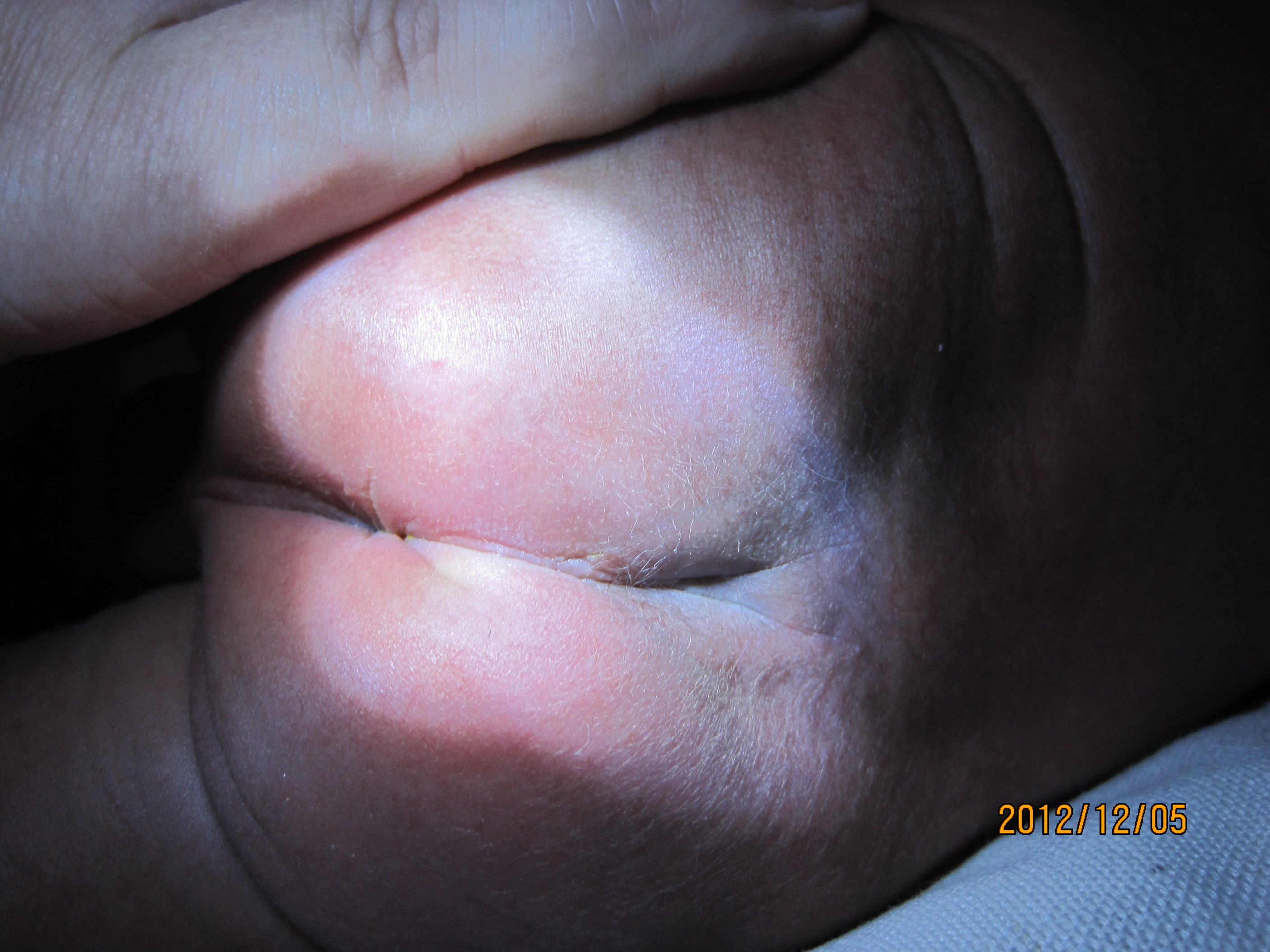 请问能否看出孩子是否是隐性脊柱裂__寻医问