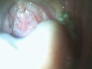 我有慢性咽炎滤泡增生_湖南省中医附一医院李