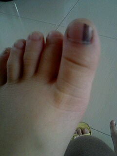 脚指甲黑色素瘤+可以手术切除吗