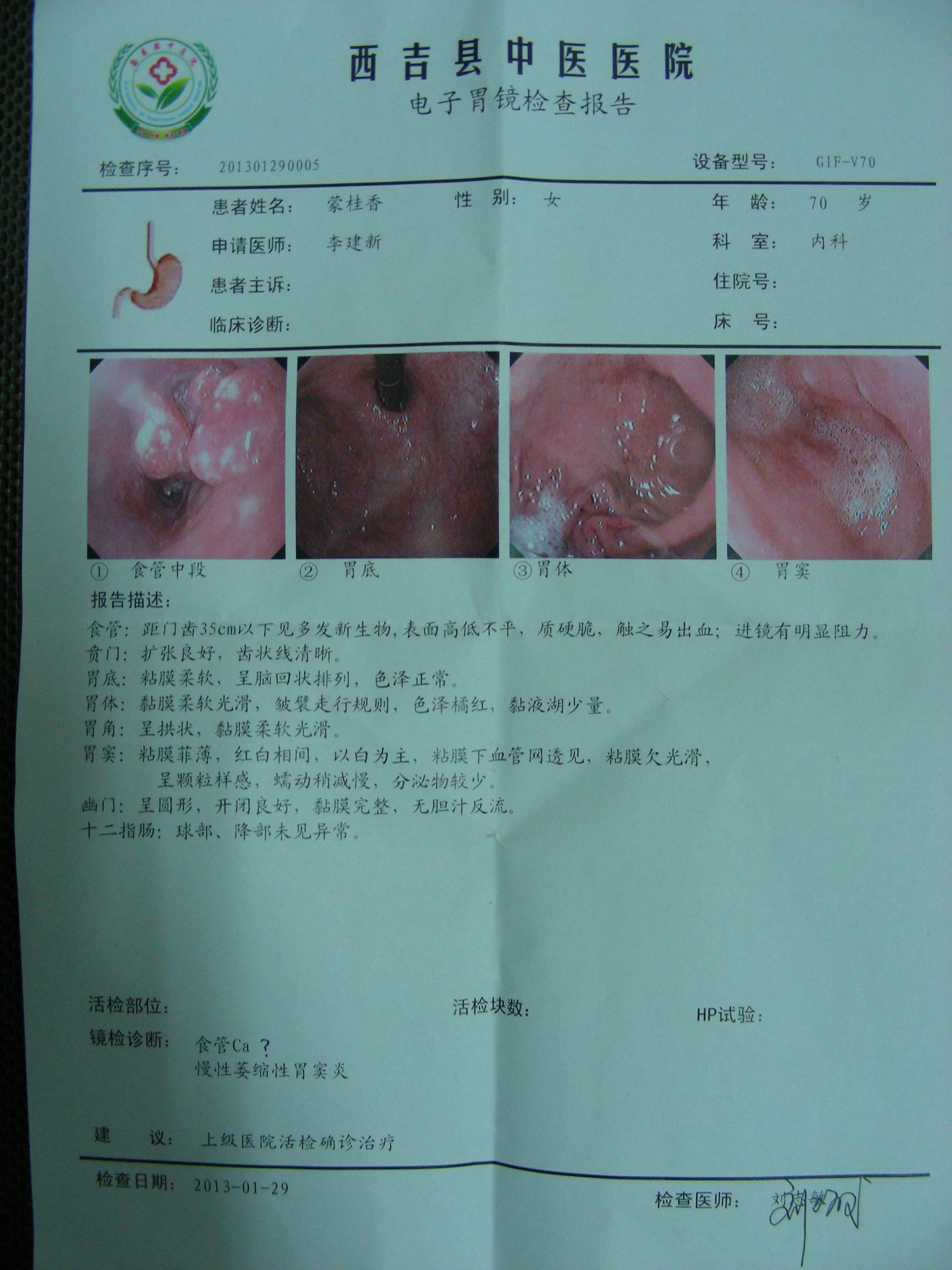 质硬脆,触之易出血,进镜有明显阻力,  贲门;扩张良好,齿状线清晰,  胃