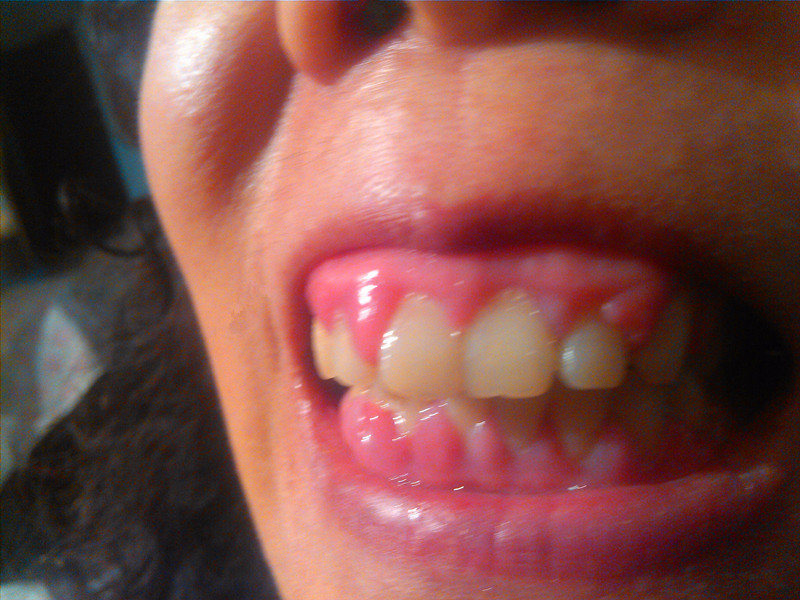 我妈妈口腔长了牙龈瘤,怎样治疗_江苏省口腔医院武和明