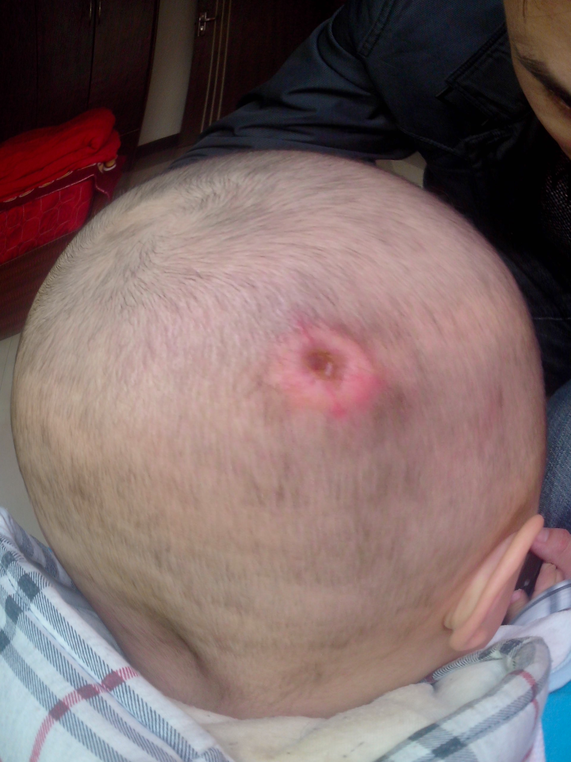 我儿子生下来<em>几天</em>后摸到<em>头发里</em>一颗米粒大的硬