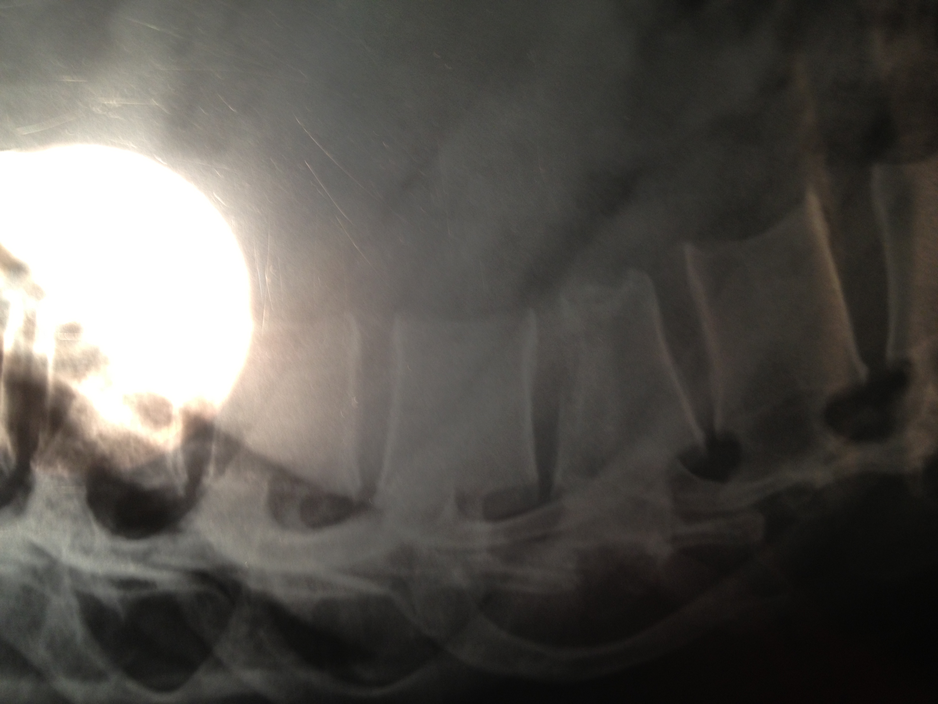 12胸椎压缩性骨折,应该是手术还是保守治疗?_