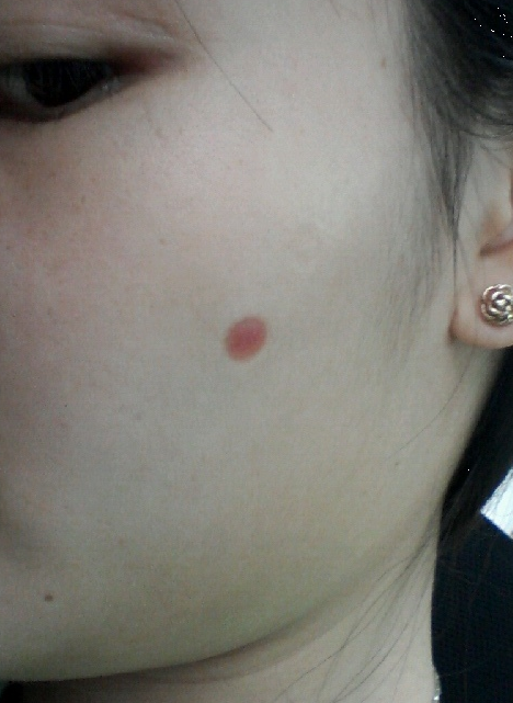 我的疤痕是自己买药点痣留下的,凹疤长平,偏红