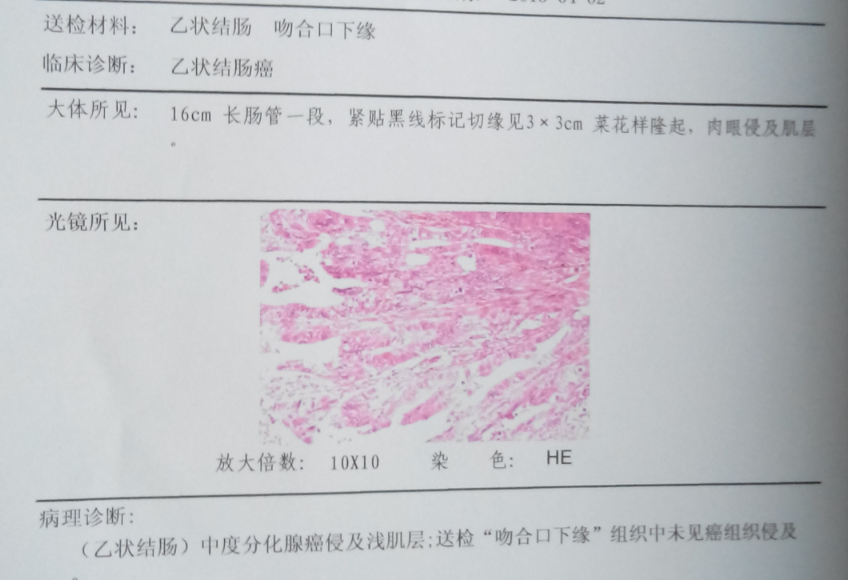 咨询区 > 咨询详情 2013年2月份出现便血,3月份去医院做肠镜,切片检查