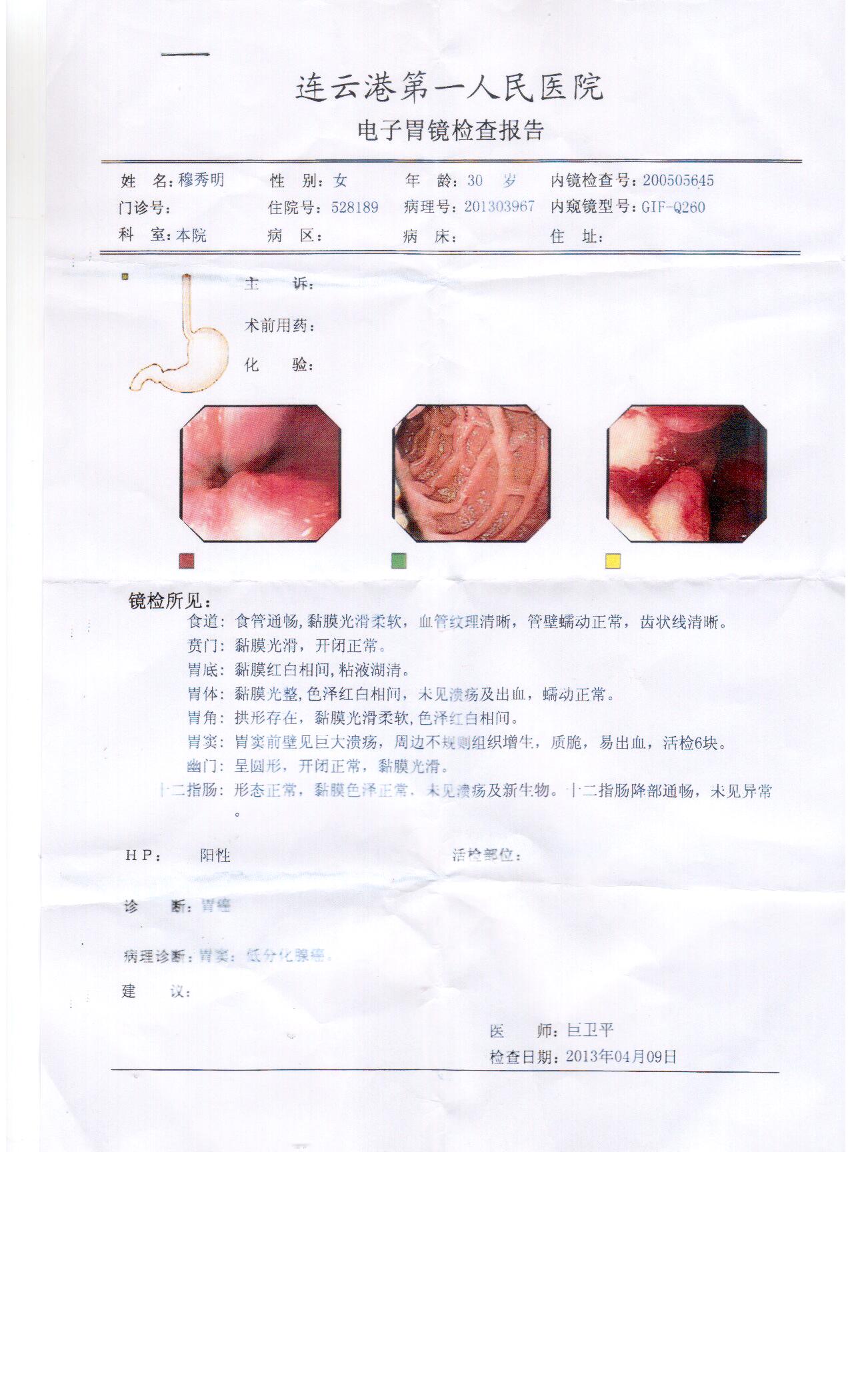 胃癌中晚期胃窦低分化腺癌并已扩散至盆腔__寻医问药