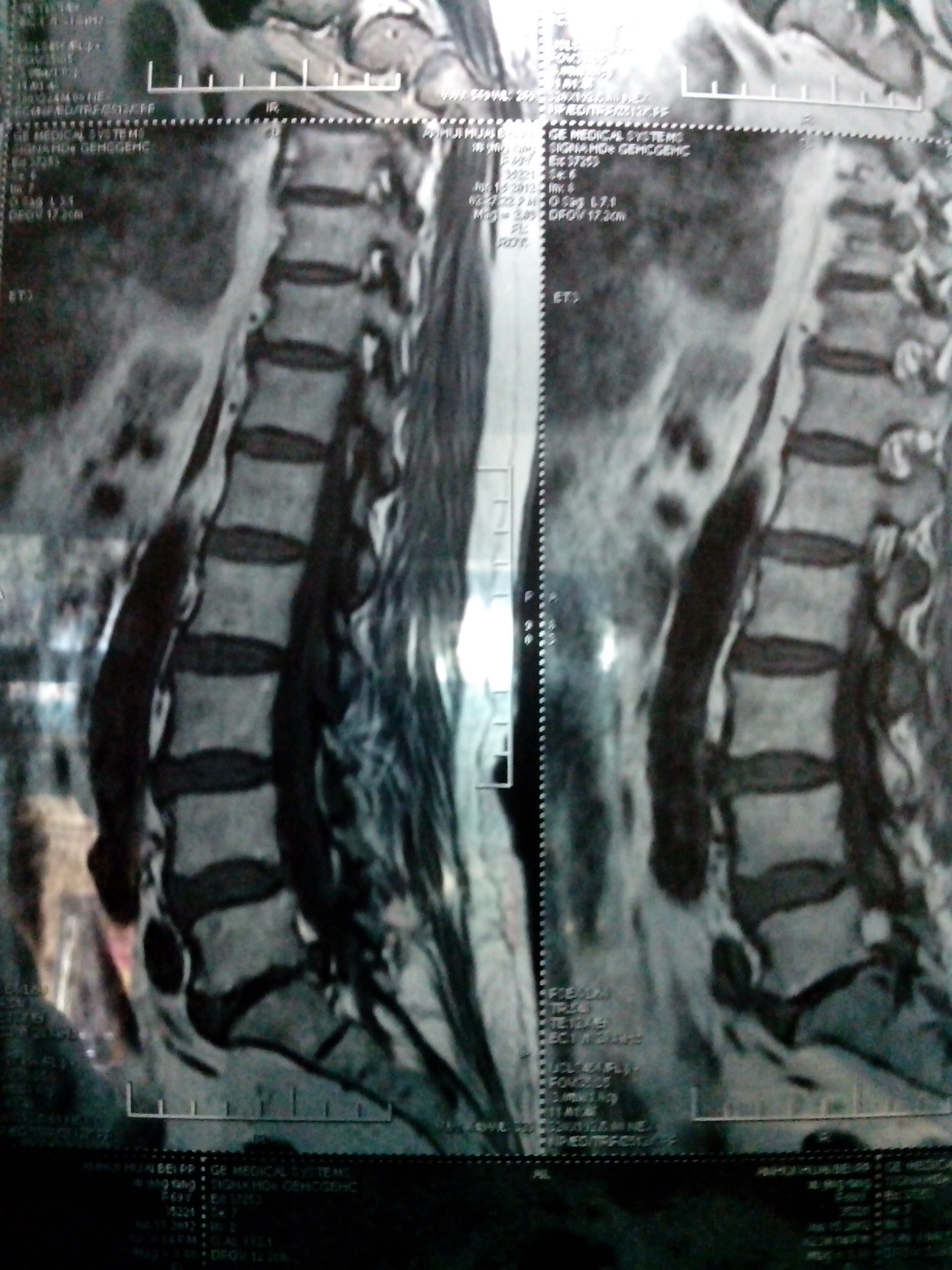 我妈腰间盘突出左腿肌肉萎缩,腿痛,走路困难,求