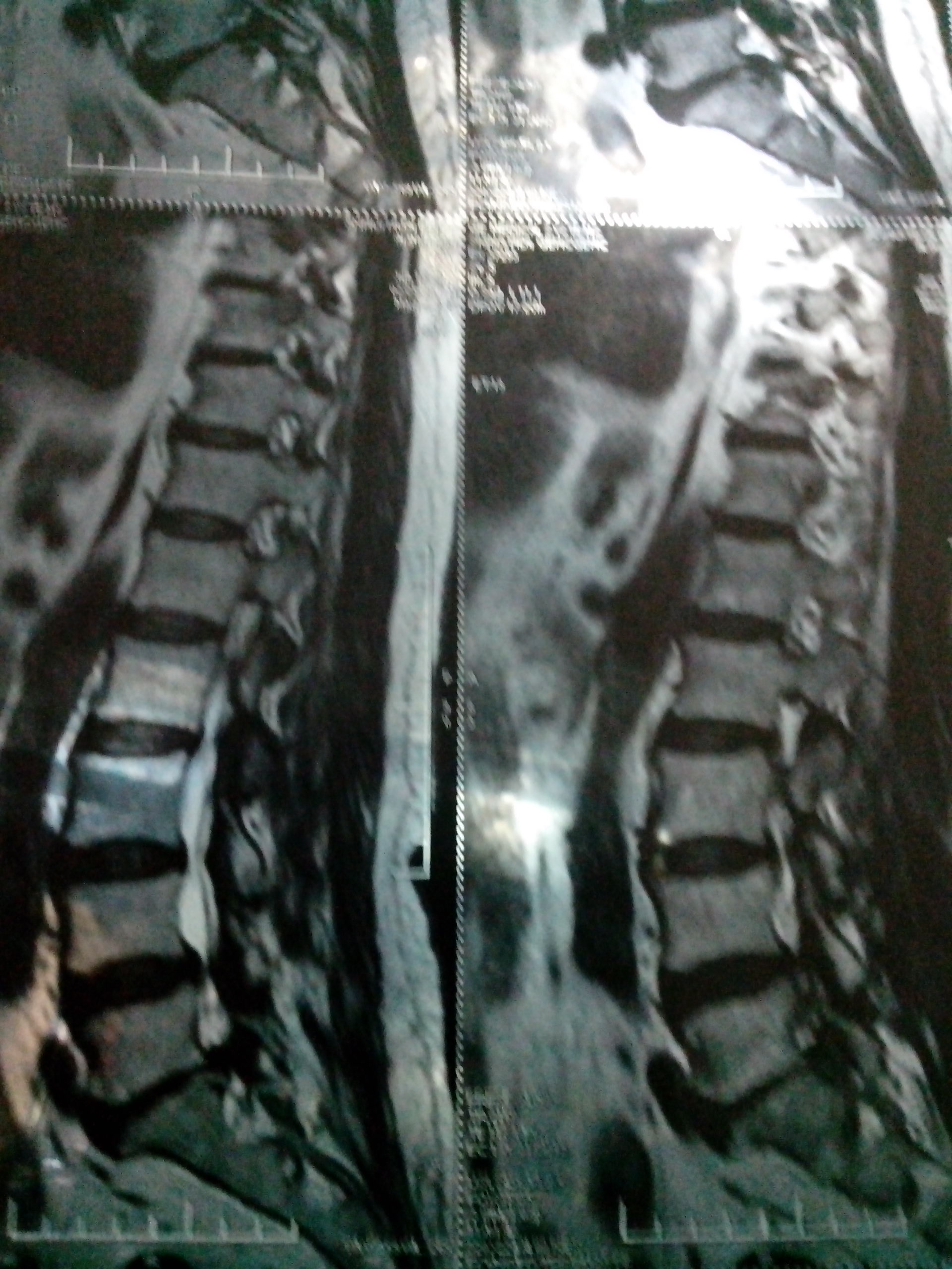 我妈腰间盘突出左腿肌肉萎缩,腿痛,走路困难,求