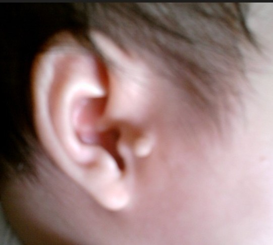 宝宝生下来耳朵后面长有一个小肉瘤疙瘩,越长