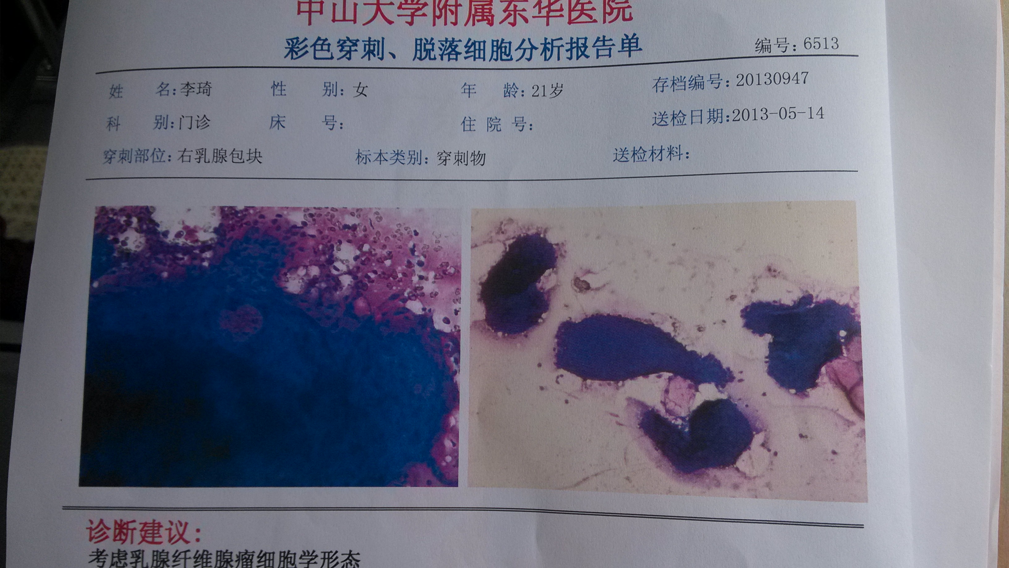 乳腺纤维瘤做微创手术全部费用多少钱_青岛市