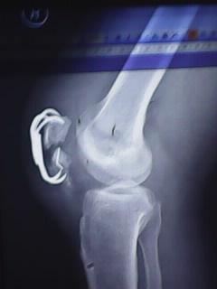 做右髌骨爪手术后.做康复运动弯曲过大裂开