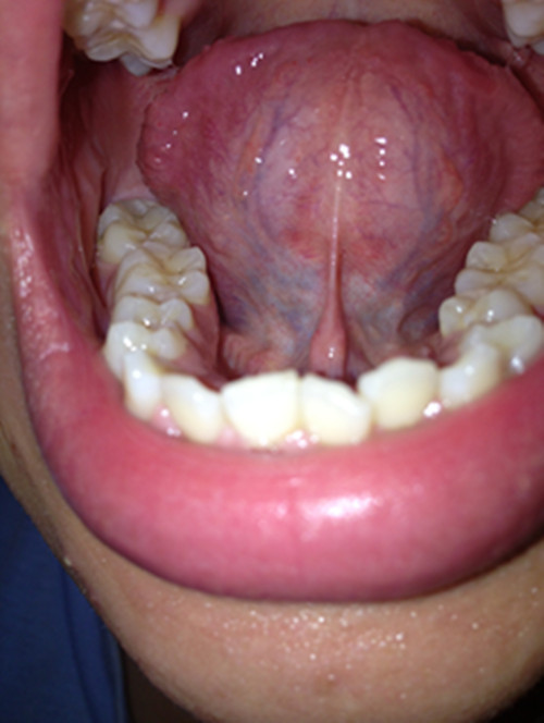 口腔内下唇内壁下颚舌根起泡怀疑是口腔尖锐湿疣