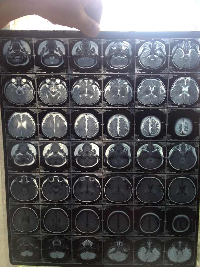 追问这是核磁共振片,麻烦医生帮我看一下,谢谢丛医生