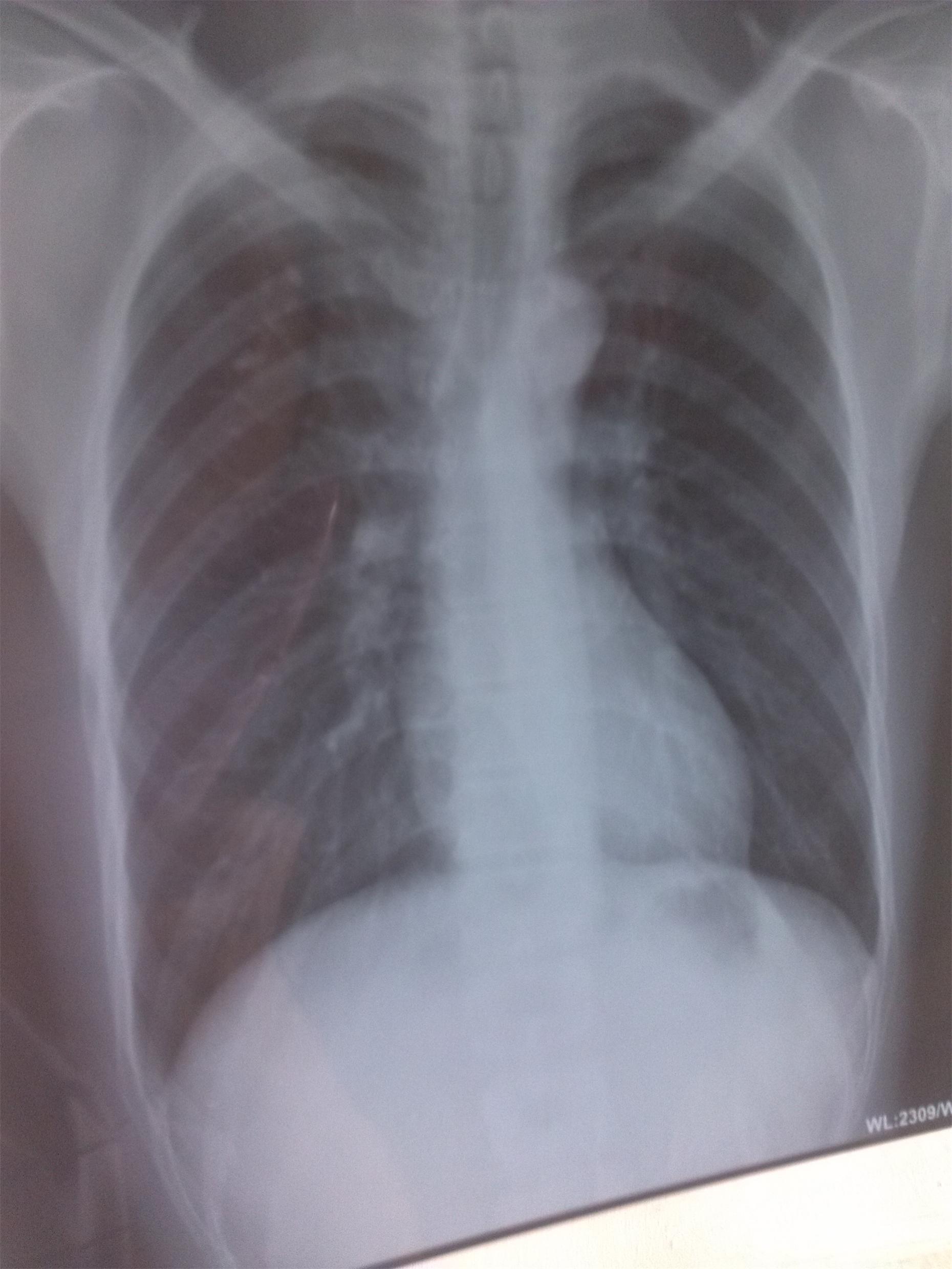 右上肺纤维,钙化病灶
