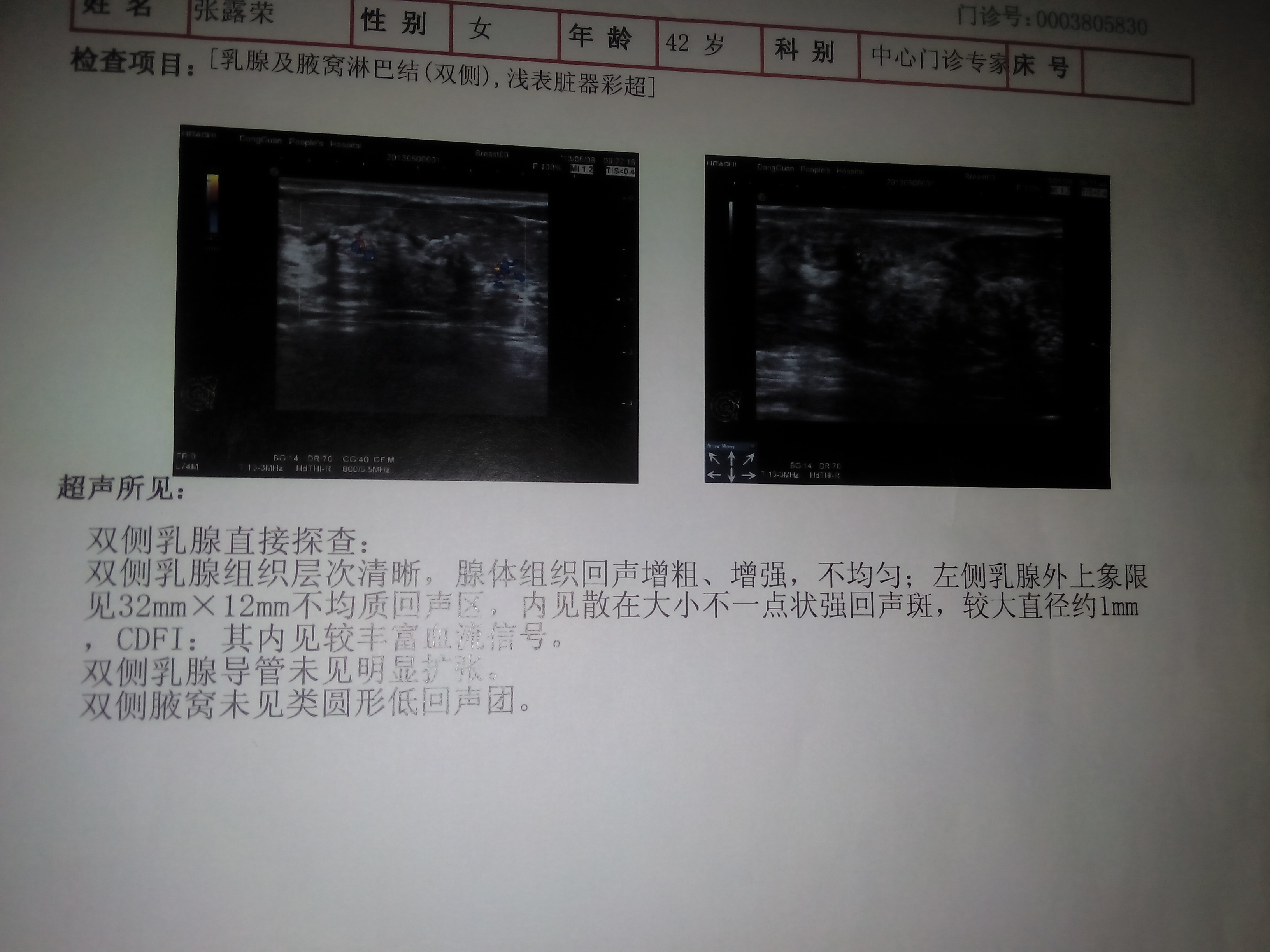 问题:你好,我老婆乳腺x线摄片诊断报告显示:双侧乳腺呈多量腺体型