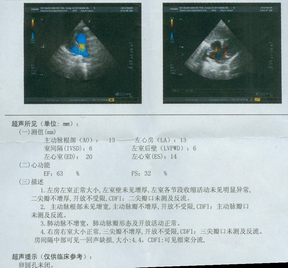 卵圆孔手术 卵圆孔闭合手术保险给报吗