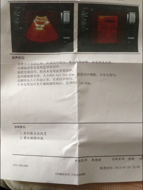 问题:前列腺炎性改变 鞘膜积液